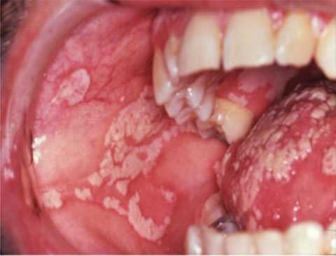 Кандидоз во рту. Кандидоз во рту.
