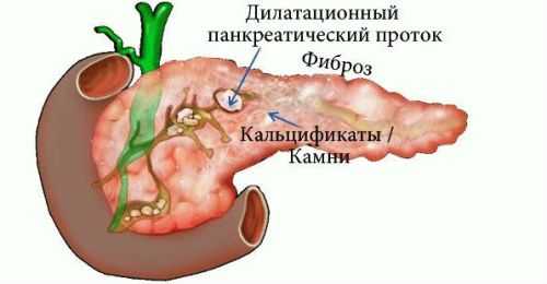 Кальцификаты в тканях поджелудочной железы