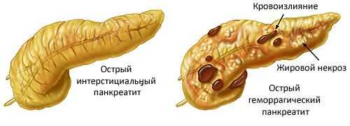 Острый панкреатит