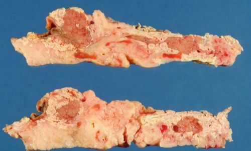 Панкреонекроз