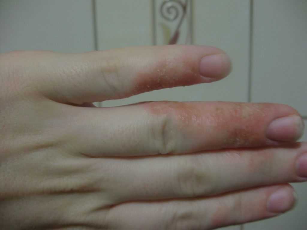 Кожные инфекции и кандидозы