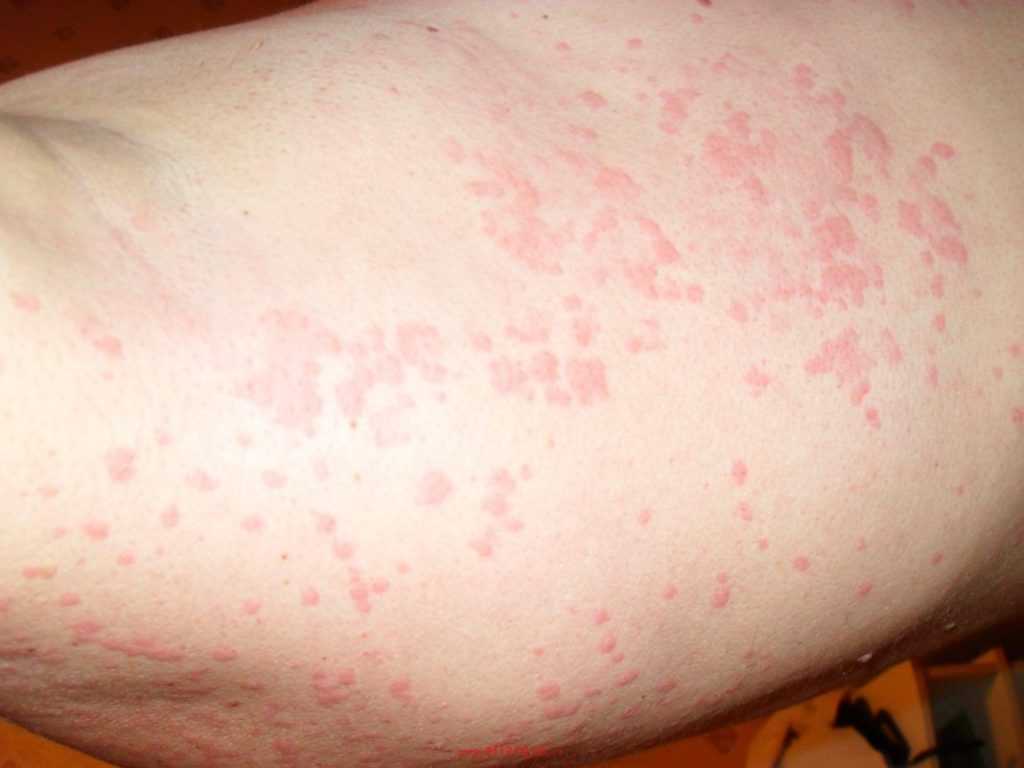 Побочные действия