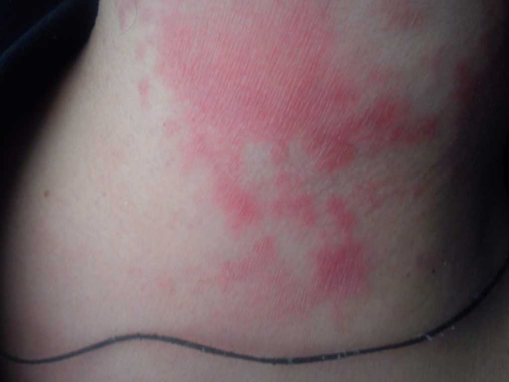 Липодистрофия