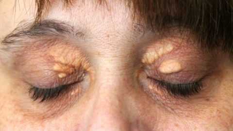 Ксантелазма (Xanthelasma) при СД Ксантелазма (Xanthelasma) при СД