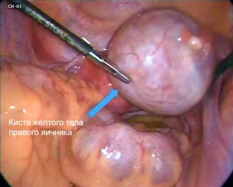 Лапароскопия кисты яичника Лапароскопия кисты яичника
