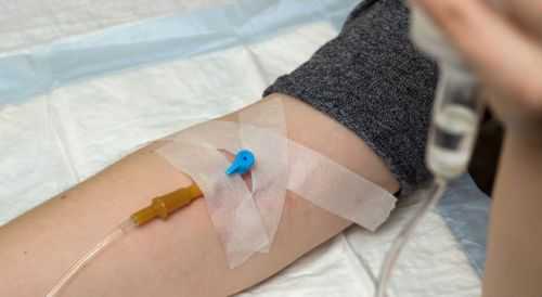 Внутривенный катетер