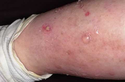 Липидный некробиоз в виде пятен и волдырей на ногах при диабете Липидный некробиоз в виде пятен и волдырей на ногах при диабете