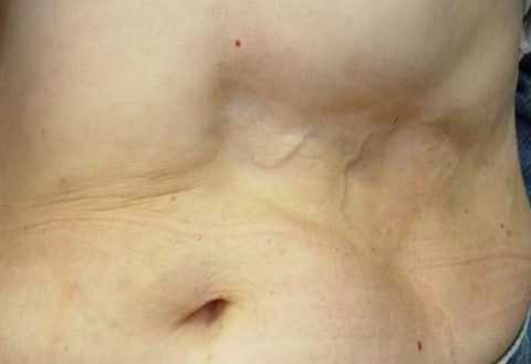 Липодистрофия в месте введения инсулина. Липодистрофия в месте введения инсулина.