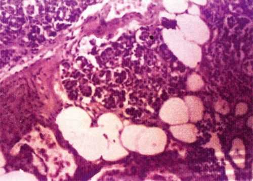 Липоматоз поджелудочной