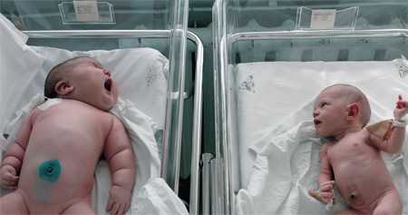 Макросомия (крупный плод). Макросомия (крупный плод).