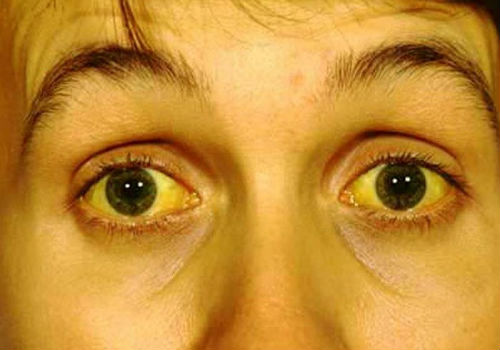 пожелтение кожных покровов и глаз