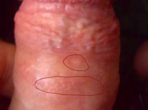 Механизм сращивания крайней плоти и головки пениса требует только оперативного вмешательства.