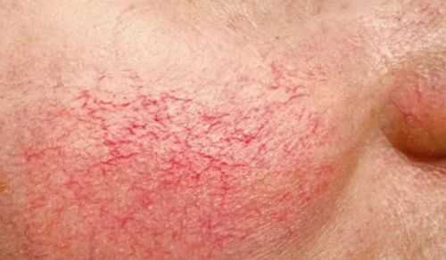 телеангиоэктазия