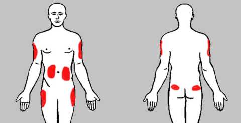 Места для введения инсулинового гормона Места для введения инсулинового гормона