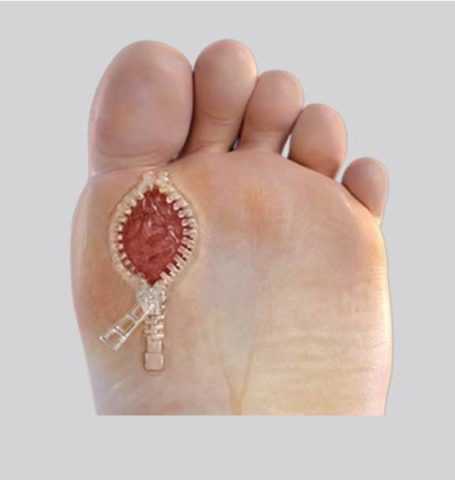 Местное лечение повреждений на коже при высоком сахаре в крови Местное лечение повреждений на коже при высоком сахаре в крови