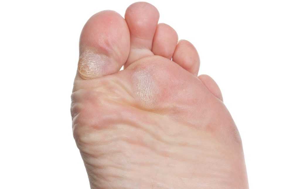 Гиперкератоз