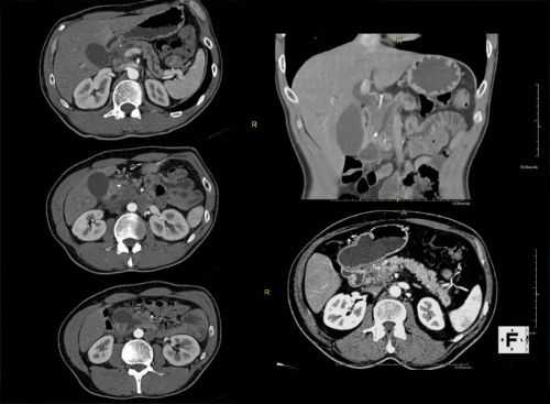 Снимок МРТ поджелудочной железы