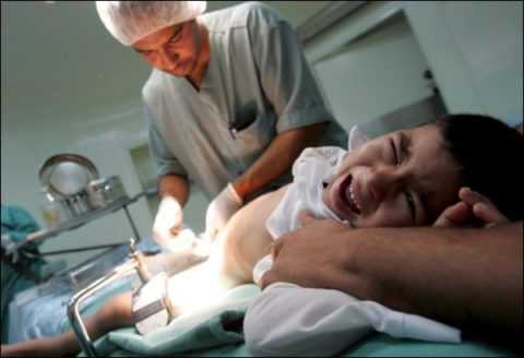 Мужчины, которым в раннем детстве провели обрезание, менее подвержены риску развития диабетического баланопостита.