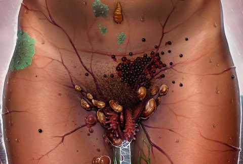 На фоне СД возникают половые инфекционные заболевания На фоне СД возникают половые инфекционные заболевания