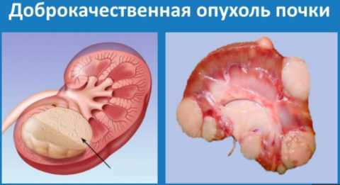 Наличие новообразований провоцирует сбой в работе всего организма, приводя к снижению уровня глюкозы. Наличие новообразований провоцирует сбой в работе всего организма, приводя к снижению уровня глюкозы.