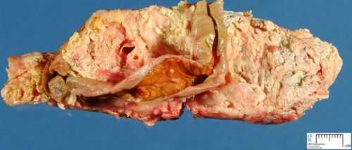 Некроз поджелудочной железы