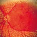 Непролиферативная стадия