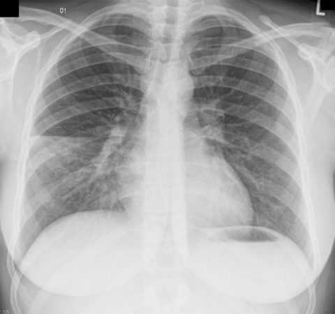 Нередко пневмония является тем провоцирующим фактором для осложнения течения СД. Нередко пневмония является тем провоцирующим фактором для осложнения течения СД.