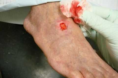Незаживающие раны у диабетиков в основном образуются на ногах и стопах, такое явление получило название диабетическая стопа. Незаживающие раны у диабетиков в основном образуются на ногах и стопах, такое явление получило название диабетическая стопа.