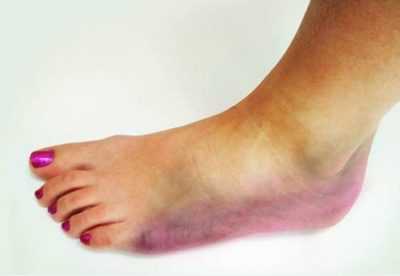 Гангрена нижних конечностей – следствие сахарного диабета