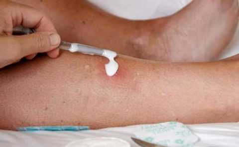 Обработка плохо заживающей раны при повышенной глюкозе в крови Обработка плохо заживающей раны при повышенной глюкозе в крови