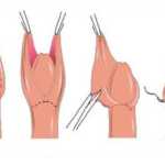Обрезание крайней плоти при баланопоститах или баланитах