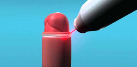 Обрезание плоти лазером Обрезание плоти лазером