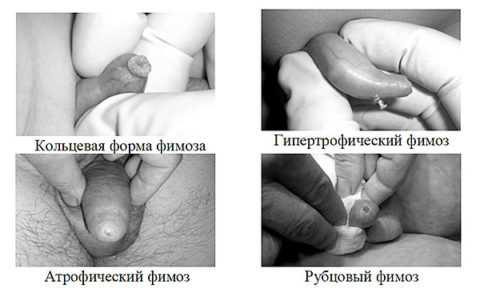 Одним из самых опасных осложнений баланопостита является развитие фимоза.