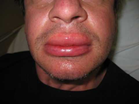 Опасность! Отек Квинке!