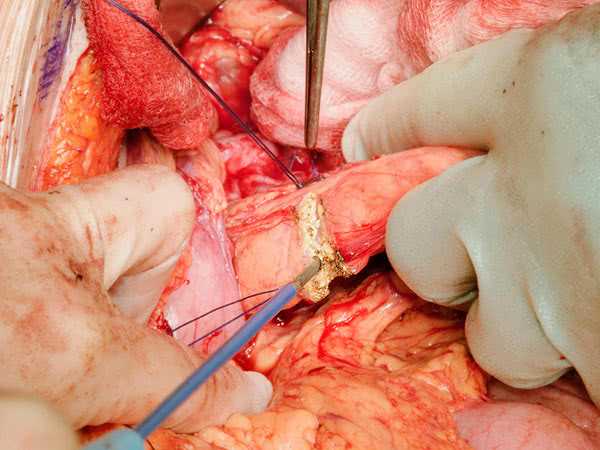 Операция на поджелудочную железу