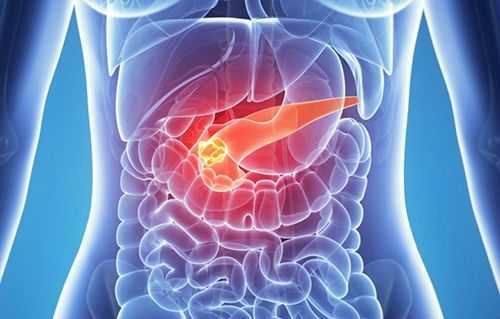 Опухоль поджелудочной железы