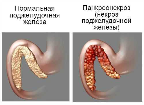 Панкреонекроз