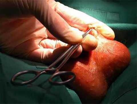 Операция на мошонке при остром и хроническом эпидидимите Операция на мошонке при остром и хроническом эпидидимите