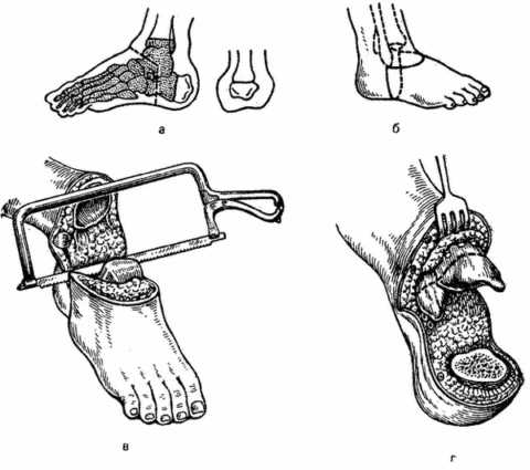 Операция по Пирогову. После заживления больной может обходиться без протеза Операция по Пирогову. После заживления больной может обходиться без протеза