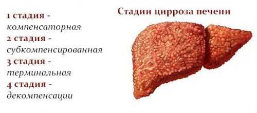 Стадии цирроза печени