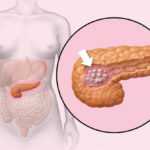 Опухоль ПЖ, вырабатывающая гормоны