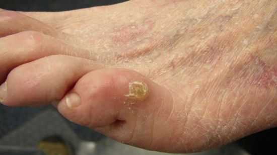 Диабетическая стопа