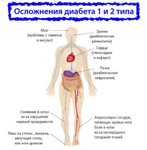 Осложнения диабета Осложнения диабета