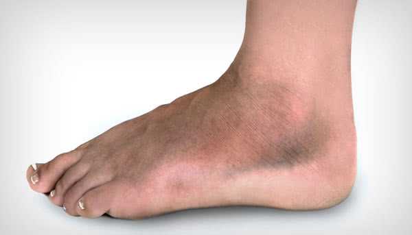 Причина отека ног