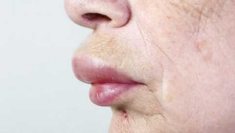 Отек Квинке при аллергии. Отек Квинке при аллергии.