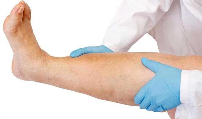 Отеки ног при сахарном диабете