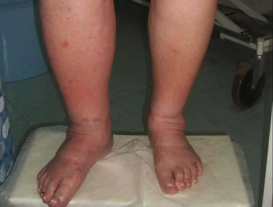 Причины возникновения отеков при диабете