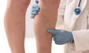 Отеки при диабете как лечить