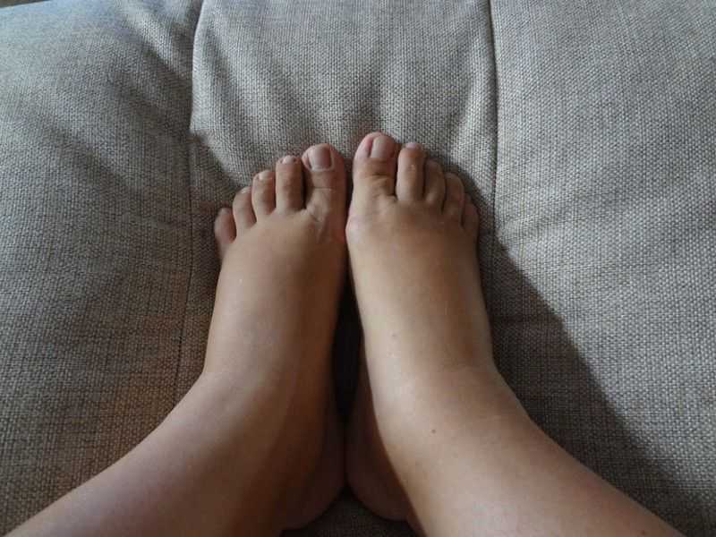 Нейропатические отеки и их опасность