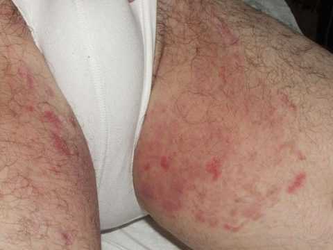 Паховая эпидермофития